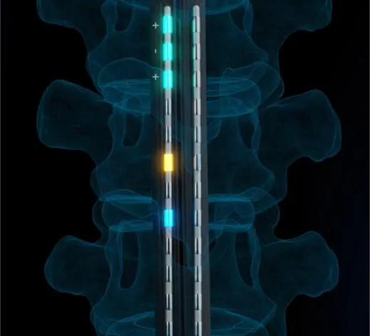 Diagram from Saluda Medical, Inc’s announcement “Quarterly Investor Presentation”